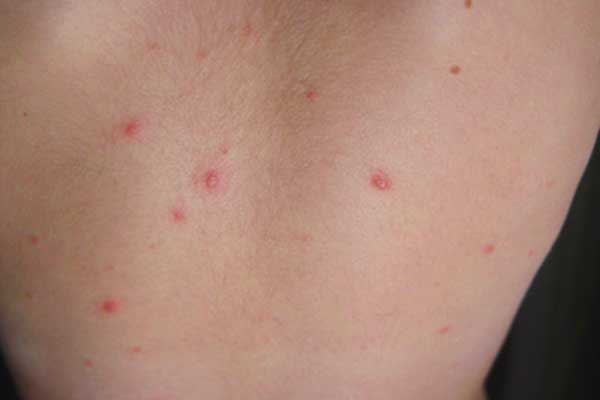 what-is-mold-rash-how-is-it-treated-symptoms-risk-factors