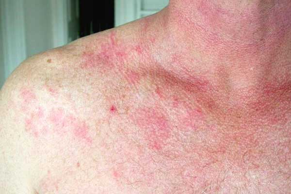 Black Mold On Skin Rash Orange Mold