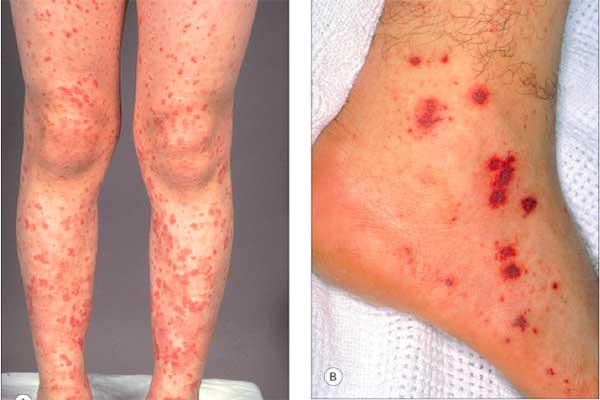 Can Mold Exposure Cause Skin Rashes