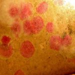 What is Red Mold, Is It Dangerous?